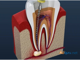 ROOT CANAL TREATMENT in Goria