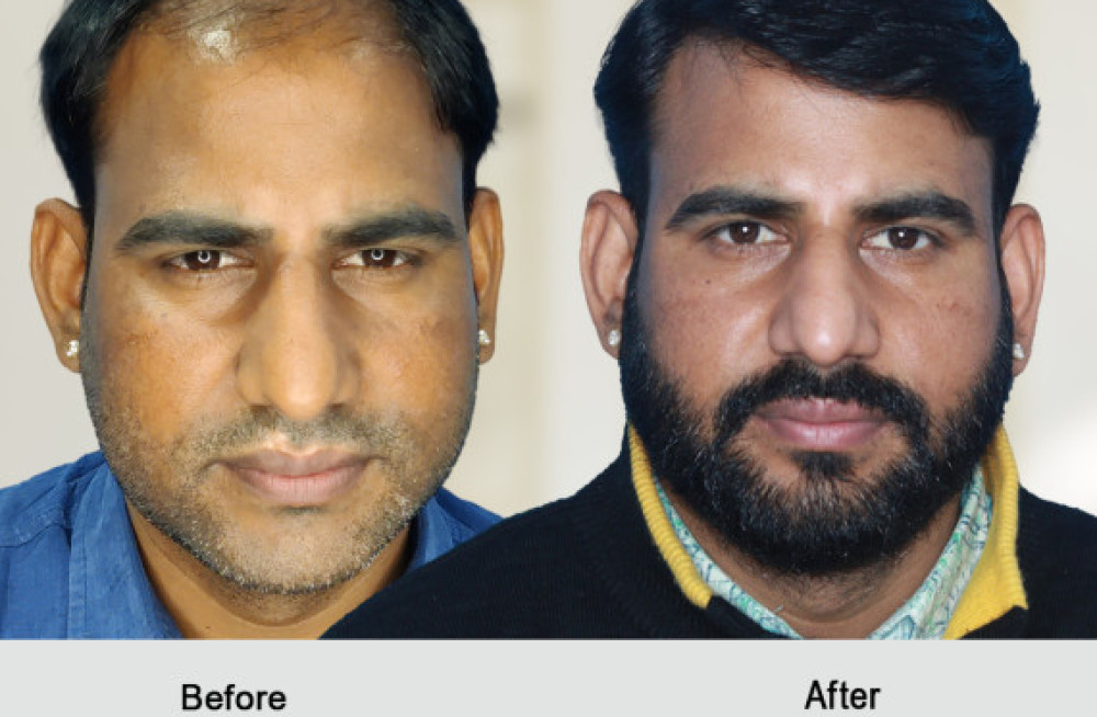 hair-transplant-in-sikar-big-0