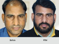 hair-transplant-in-sikar-small-0