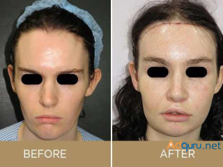 Facial Feminization Surgery Cost in the USA