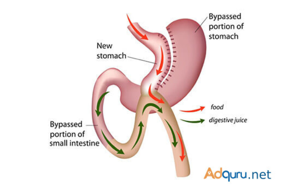 mini-gastric-bypass-surgery-at-laparo-obeso-centre-big-0