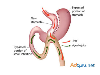 Mini Gastric Bypass Surgery at Laparo Obeso Centre