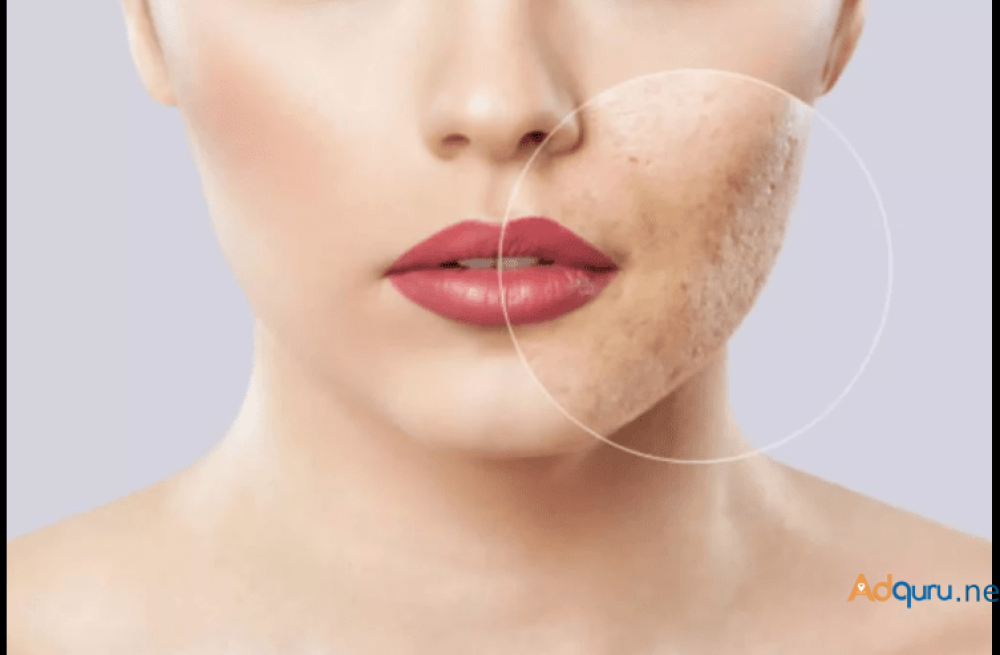 acne-treatment-kashipur-uttarakhand-big-0