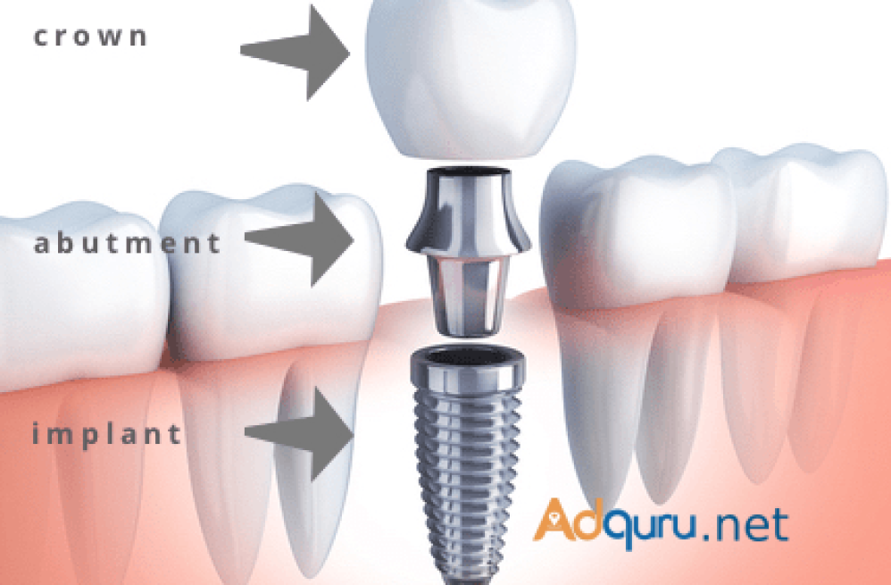 dental-implant-cost-in-gurgaon-india-dr-ravneet-kaur-big-0