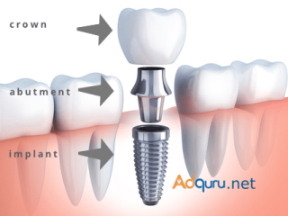 Dental Implant Cost In Gurgaon India : Dr. Ravneet Kaur