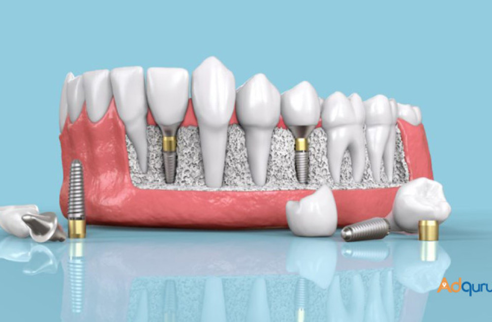 quality-dental-implants-in-india-big-1