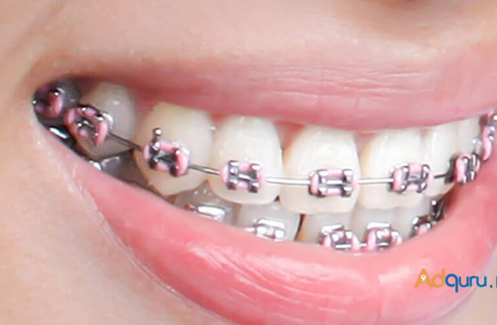 quality-dental-implants-in-india-big-0