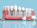 quality-dental-implants-in-india-small-1