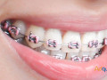 quality-dental-implants-in-india-small-0