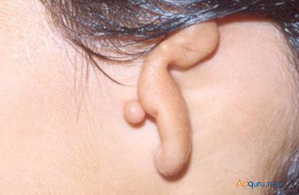 ear-reconstruction-doctor-in-uk-big-0