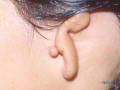 ear-reconstruction-doctor-in-uk-small-0