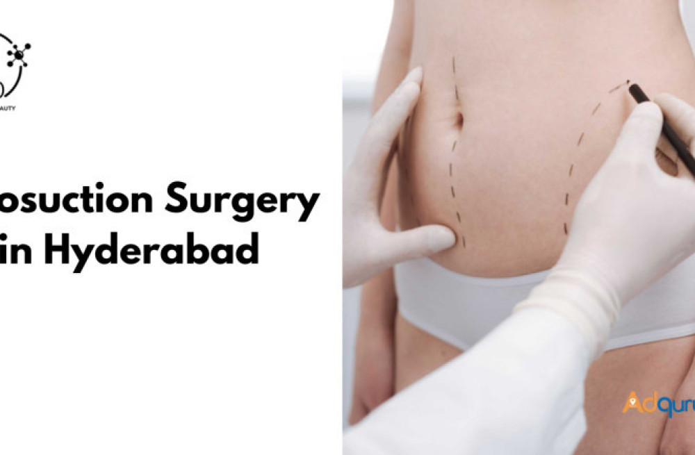 liposuction-surgery-in-hyderabad-big-0