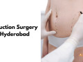 liposuction-surgery-in-hyderabad-small-0