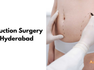 Liposuction surgery in Hyderabad