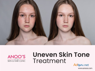 Advanced Uneven Skin Tone Treatment at Anoos