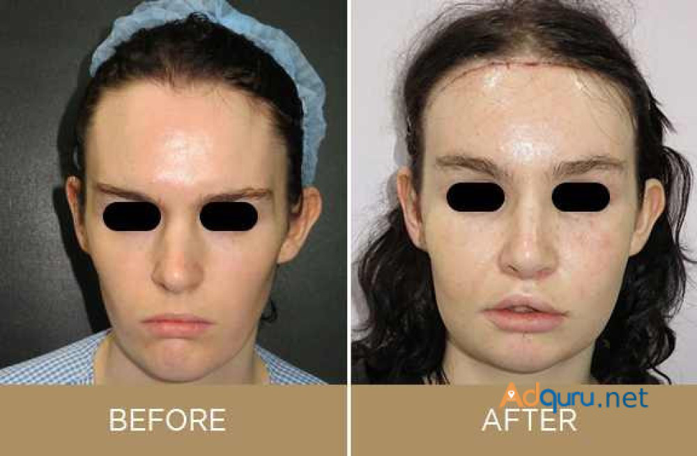 facial-feminization-surgery-usa-big-0