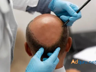 Best Hair Transplant in Greater Kailash, Delhi