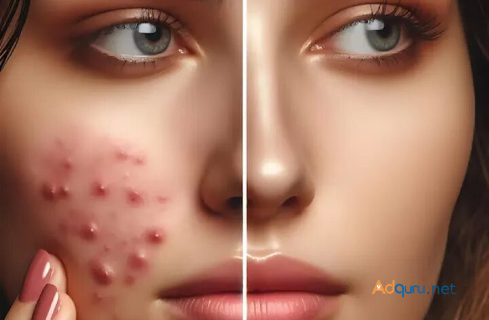 best-acne-treatment-in-delhi-at-dwc-big-0