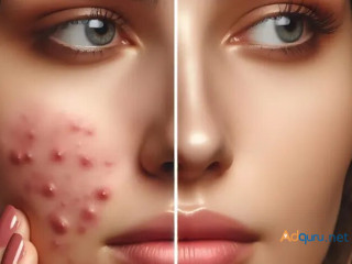 Best Acne Treatment in Delhi at DWC