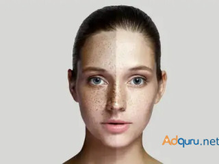 Pigmentation Treatment in Greater Kailash, Delhi | DWC