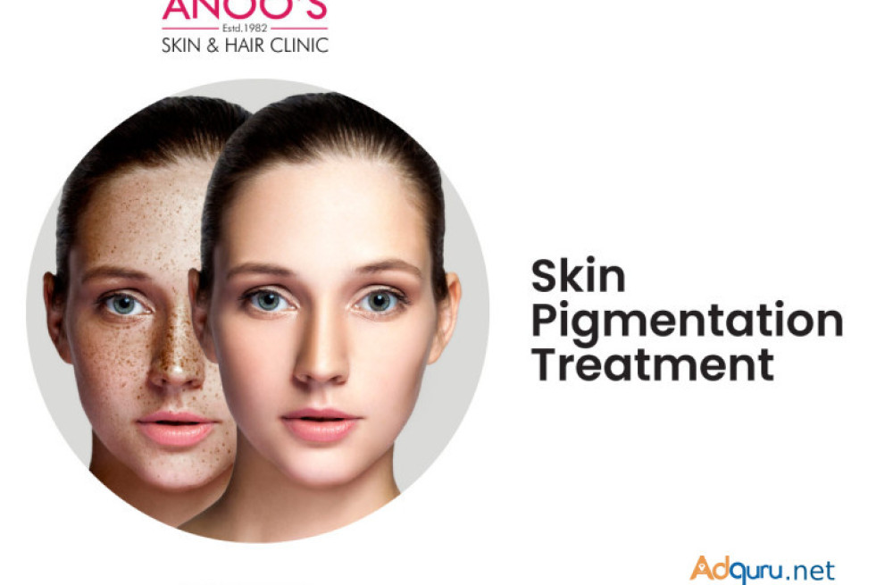 advanced-pigmentation-treatment-at-anoos-big-0