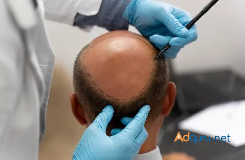 hair-transplant-in-greater-kailash-delhi-advanced-hair-treatment-big-0