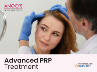 Advanced PRP Treatment for Hair Regrowth at Anoos