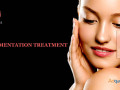 pigmentation-treatment-in-bangalore-small-0