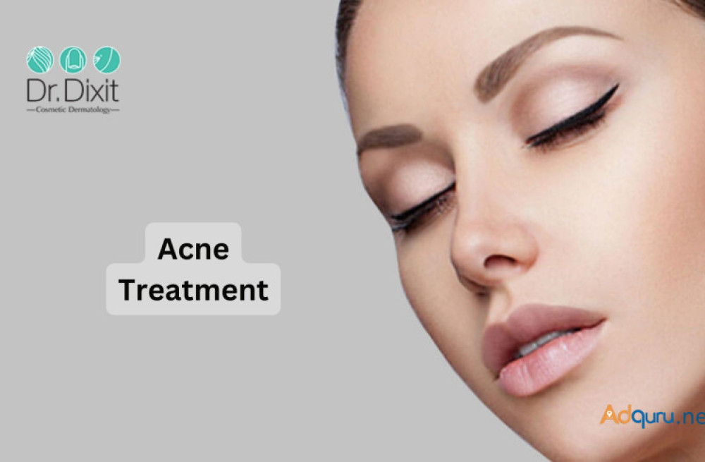 acne-treatment-in-bangalore-big-0