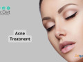 acne-treatment-in-bangalore-small-0