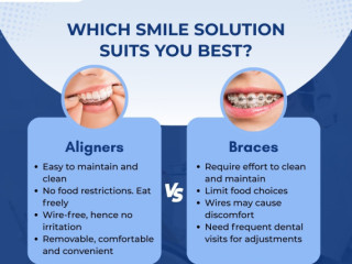 Aligners or Braces? Get Expert Advice from the Best Dentist in Delhi