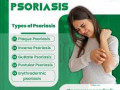 ayurvedic-remedy-for-psoriasis-in-mumbai-small-0