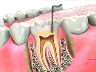 RCT Treatment in coimbatore