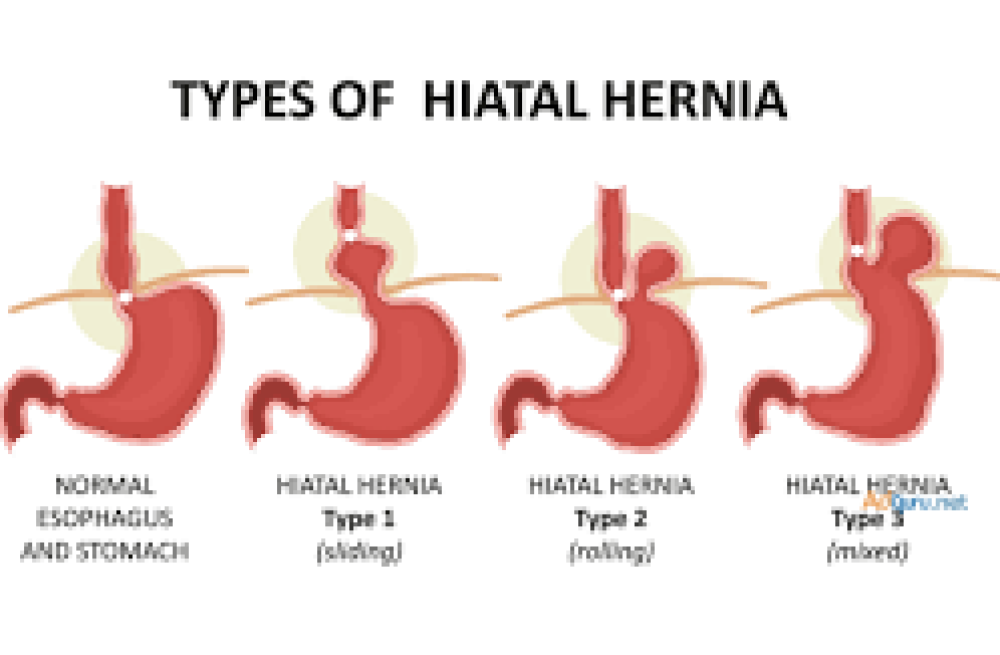 inguinal-hernia-treatment-in-mumbai-big-0