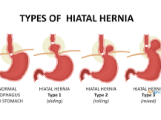 Inguinal Hernia Treatment In Mumbai