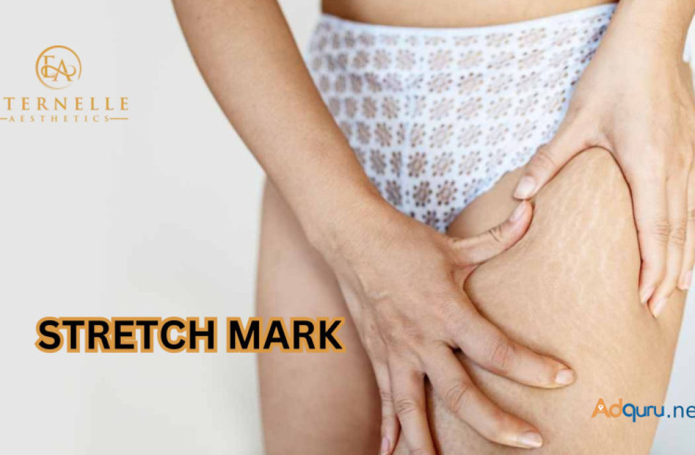 stretch-mark-removal-treatment-in-hyderabad-eternelle-aesthetics-big-0