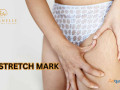 stretch-mark-removal-treatment-in-hyderabad-eternelle-aesthetics-small-0