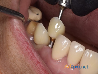 Find minimally invasive Veneers in Tijuana with ultra-thin custom-made shells