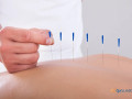 acupuncture-clinic-nyc-small-0