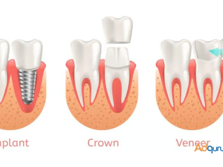 Same-Day Crowns in Las Vegas at Functional Aesthetic Dentistry