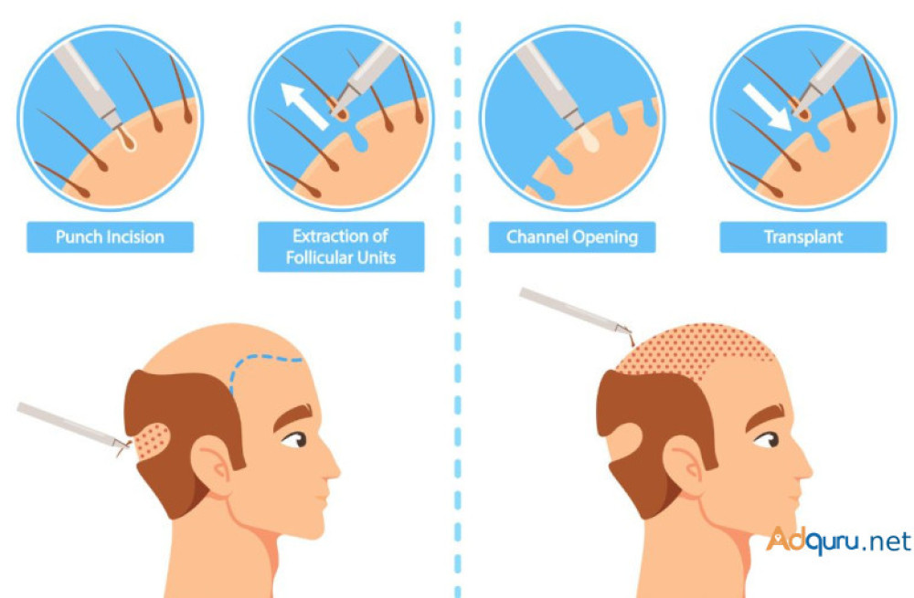 types-of-hair-transplant-surgeries-a-comprehensive-guide-big-0