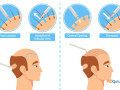 types-of-hair-transplant-surgeries-a-comprehensive-guide-small-0