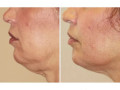 forma-skin-tightening-cost-small-0