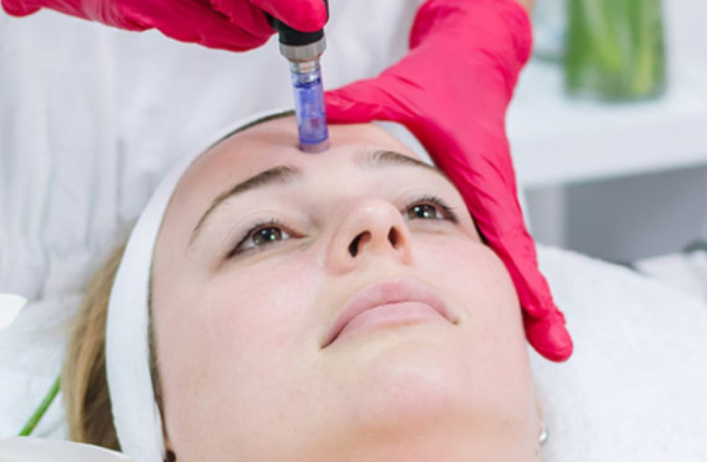 microneedling-radiofrequency-services-big-0