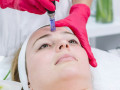 microneedling-radiofrequency-services-small-0