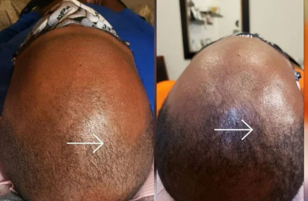 hair-loss-restoration-indianapolis-big-0