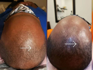 Hair Loss Restoration Indianapolis