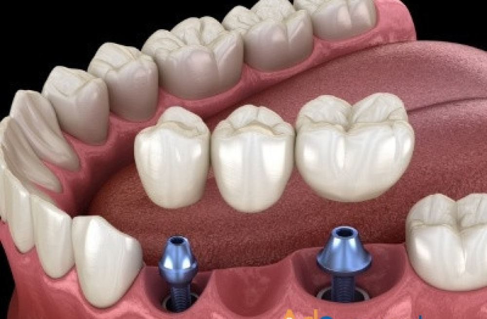 affordable-dental-implants-cost-in-euless-tx-pleasant-dental-big-0