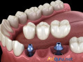 affordable-dental-implants-cost-in-euless-tx-pleasant-dental-small-0