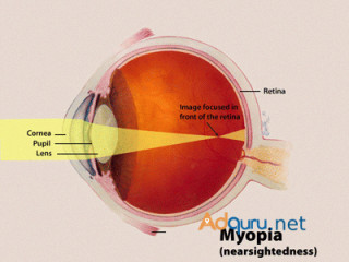 Advanced Myopia Management for Clearer Vision